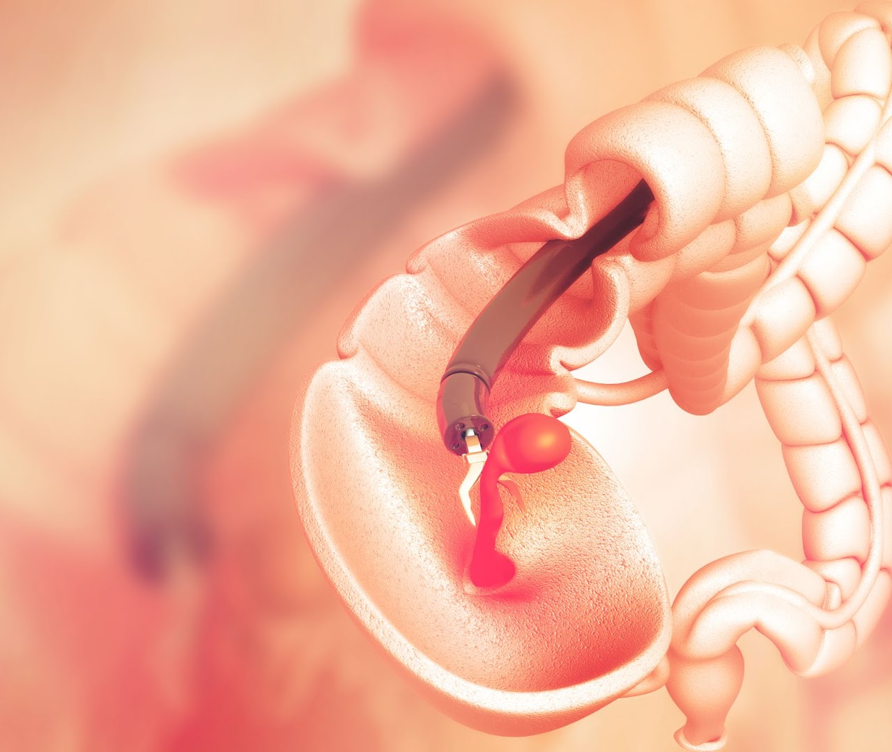 Bowel cancer screening