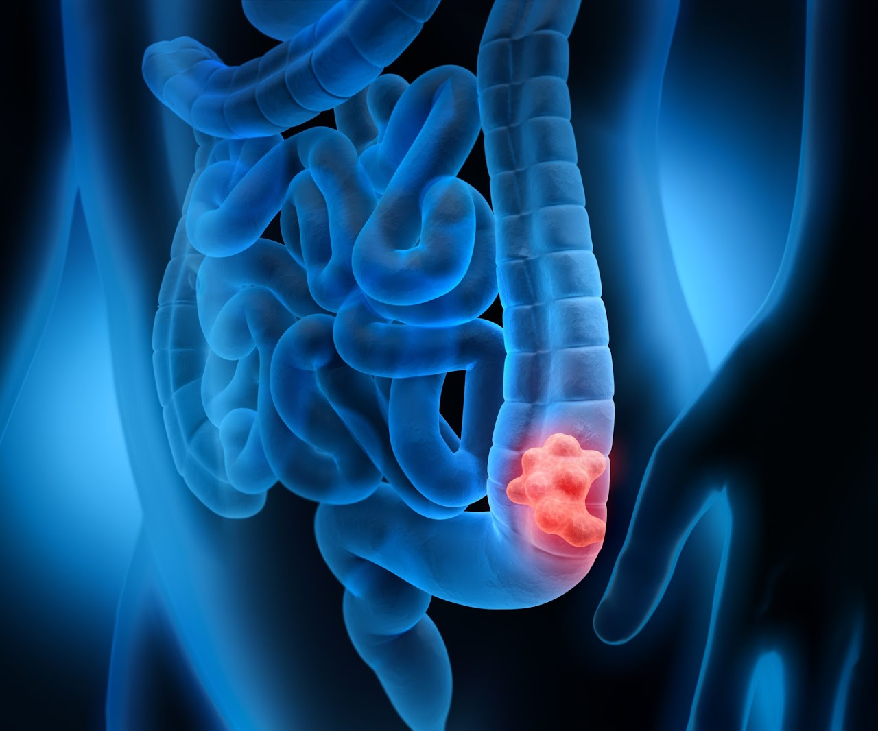 EMR/Removal of polyps